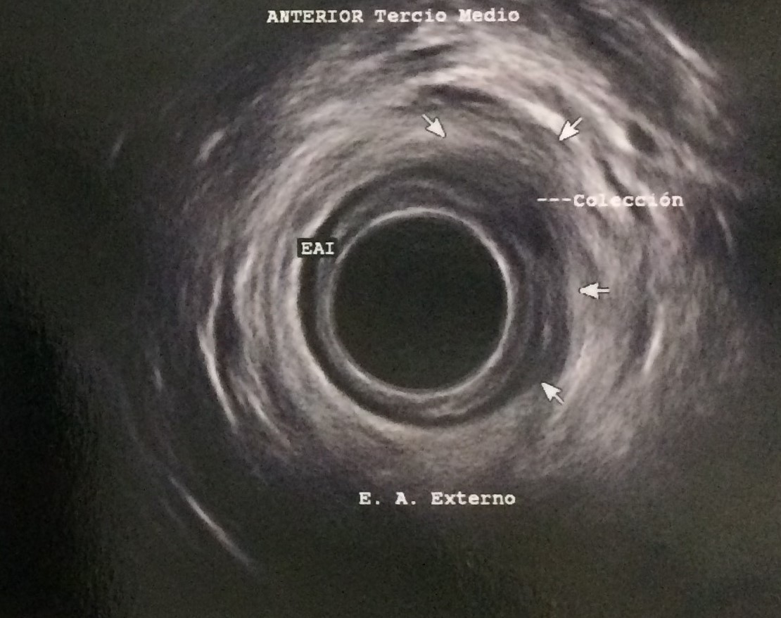 USG absceso
